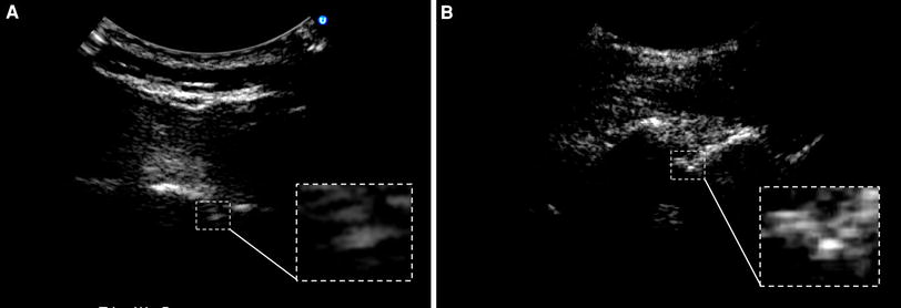 Utility of prepuncture ultrasound for localization of the ...