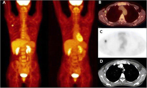 Kikuchi Disease Mimicking Metastatic Lymphadenopathy on 18F-FDG PET/CT ...