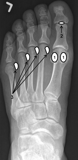 Sesamoids and accessory ossicles of the foot: anatomical variability