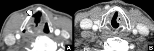 Vocal cord paralysis: anatomy, imaging and pathology | SpringerLink