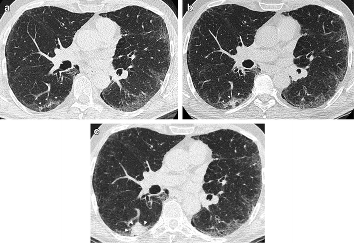 Ct Scan For Lung Nodule With Or Without Contrast - ct scan ...
