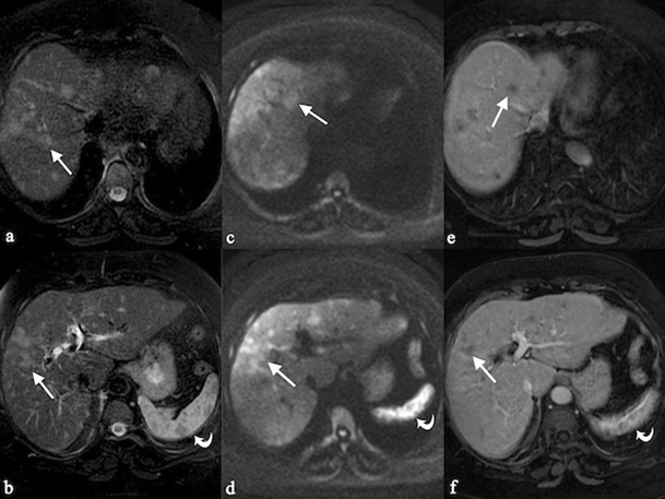 Sarcoidosis radiology picture