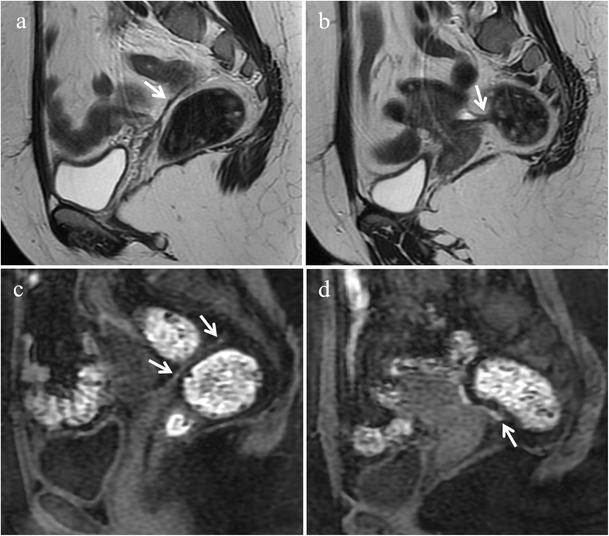 Endometriosis Clinical Features Mr Imaging Findings And Pathologic Correlation Springerlink
