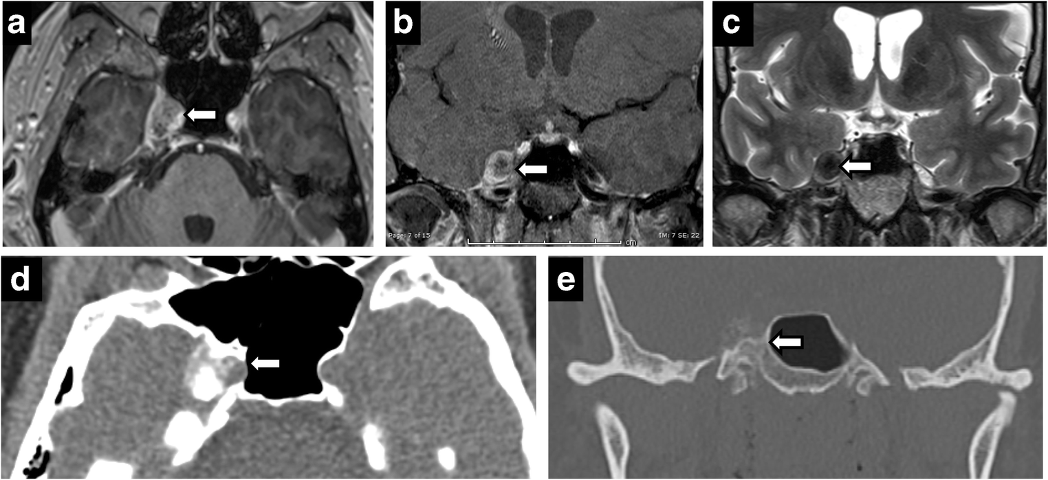 Neuroimaging of Meckel’s cave in normal and disease conditions ...