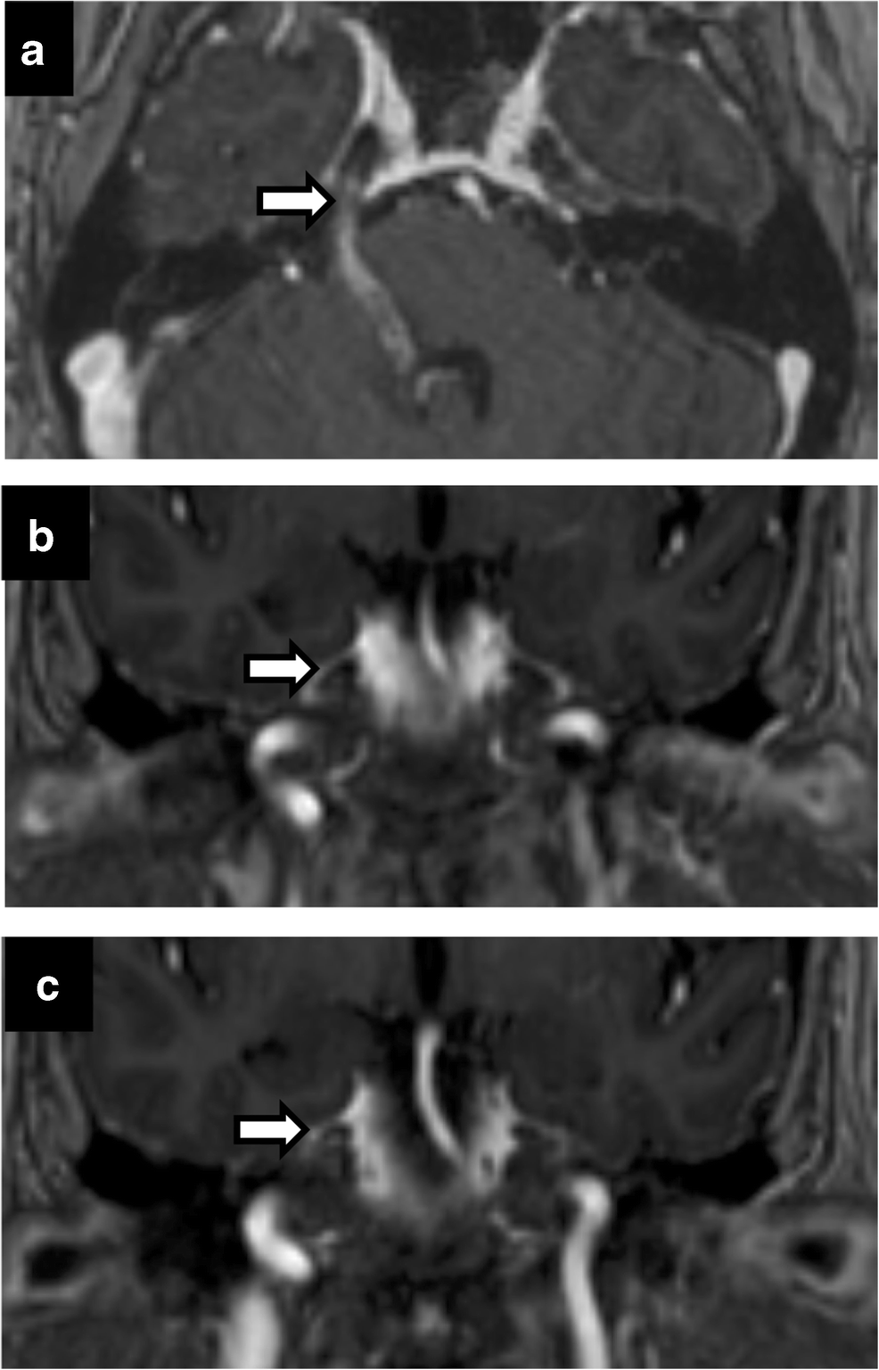 Neuroimaging of Meckel’s cave in normal and disease conditions ...