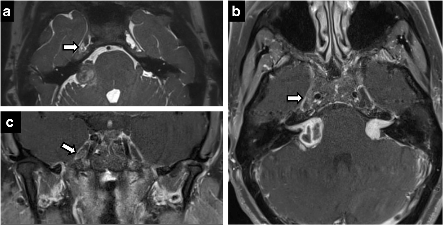 Neuroimaging of Meckel’s cave in normal and disease conditions