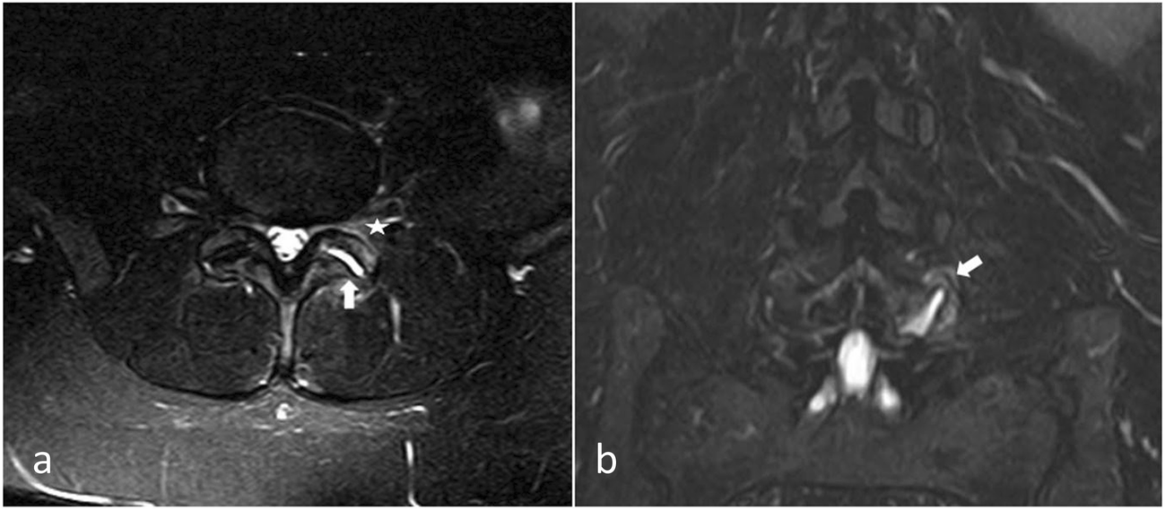 Facet joint syndrome from diagnosis to interventional management