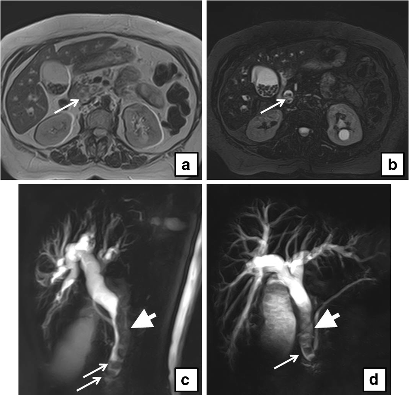 Routine MRCP in the management of patients with gallbladder stones