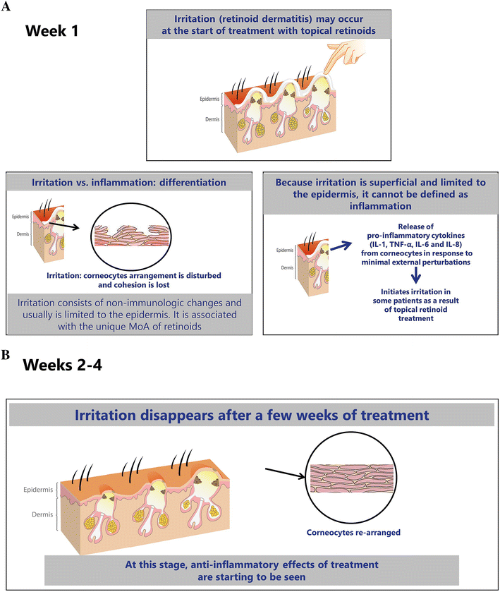 Why Topical Retinoids Are Mainstay of Therapy for Acne SpringerLink