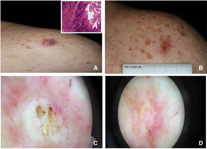 Successful Treatment of a Keratoacanthoma with 