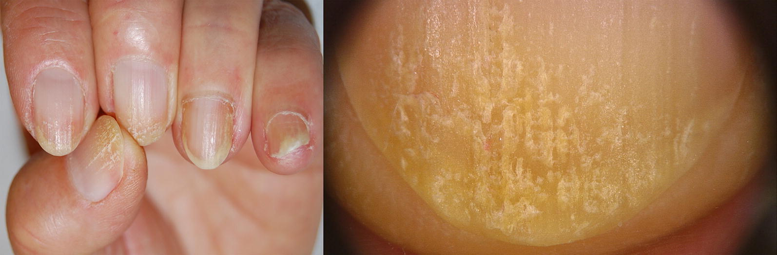 Pathogenesis, Clinical Signs and Treatment in Brittle