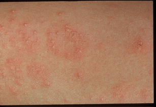 Atopic Eczema and Itch in Pregnancy: Therapeutic Considerations ...