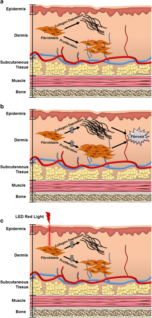 Visible Red Light Emitting Diode Photobiomodulation for Skin Fibrosis