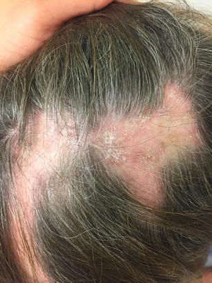 Hair and Nail Manifestations of Systemic Disease ...