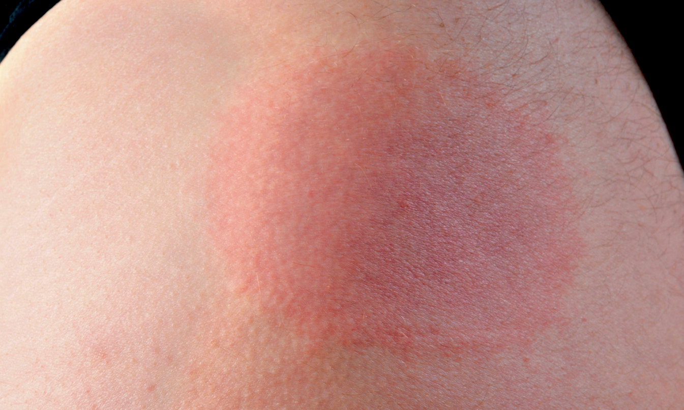 Die neun häufigsten Irrtümer über LymeBorreliose SpringerLink
