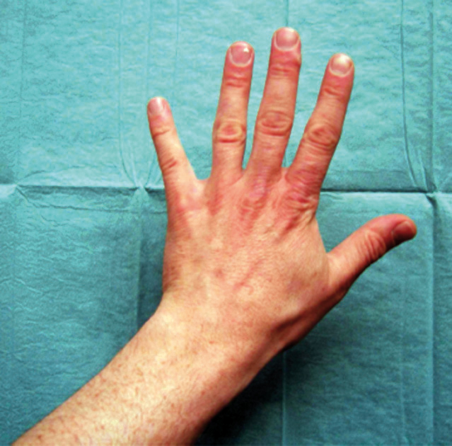 Neuer Fokus in der Therapie des Morbus Sudeck SpringerLink