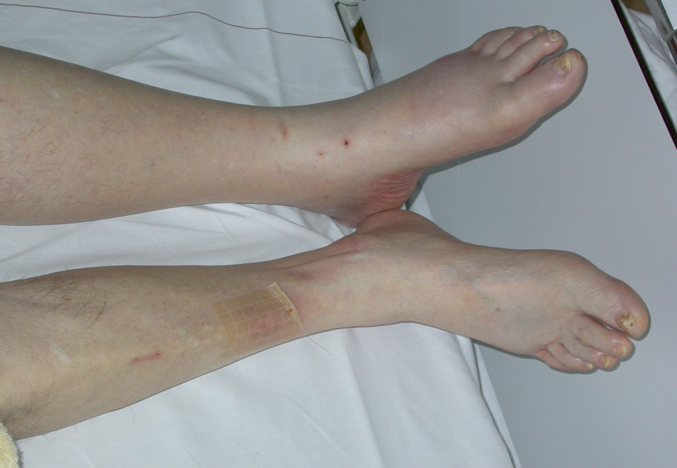 Einseitige Beinschwellung SpringerLink Einseitige Beinschwellung SpringerLink