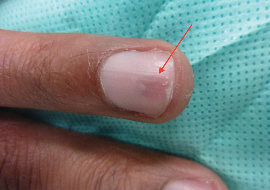 Ein Glomustumor unter dem Fingernagel SpringerLink