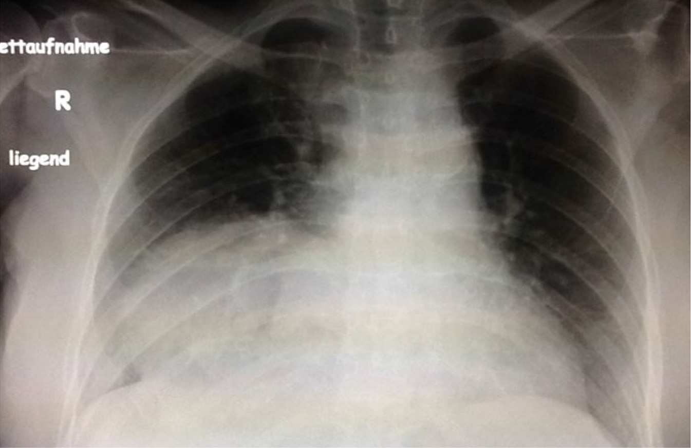 Zufallsfund bei Pneumonie-Fahndung | SpringerLink