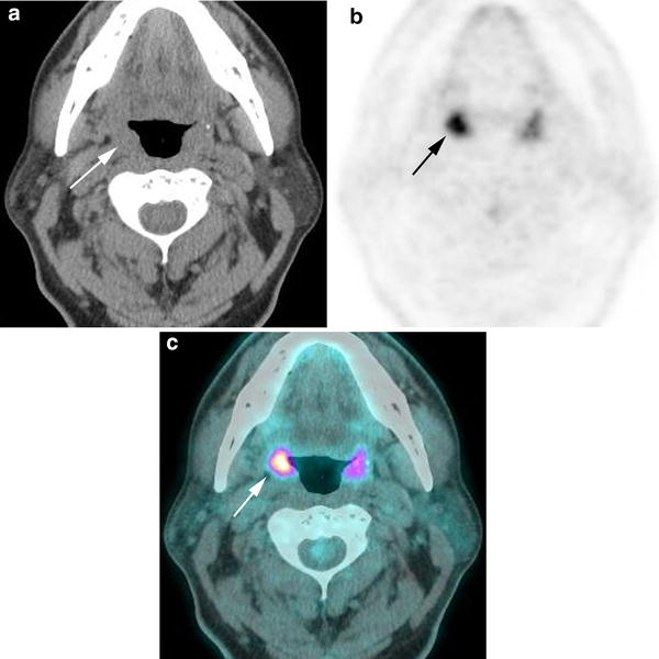 Petct For Head And Neck Squamous Cell Cancer—uses And Updates For