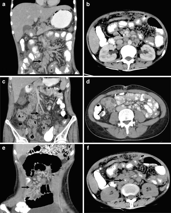 Role of CT and MRI in Abdominal Tuberculosis | SpringerLink