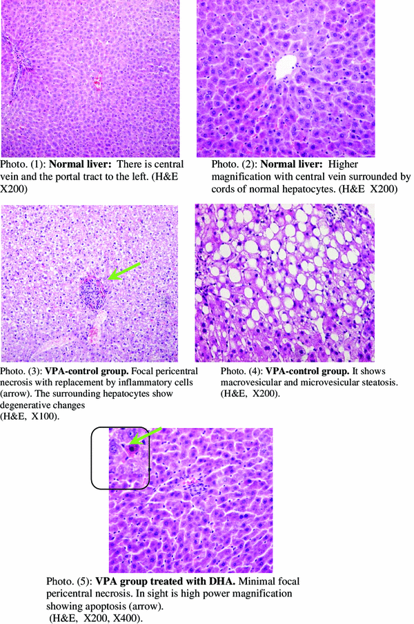 ValproateInduced Liver Injury Modulation by the Omega3 Fatty Acid