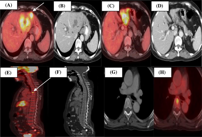 PET/CT in patients with liver lesions of different nature | SpringerLink