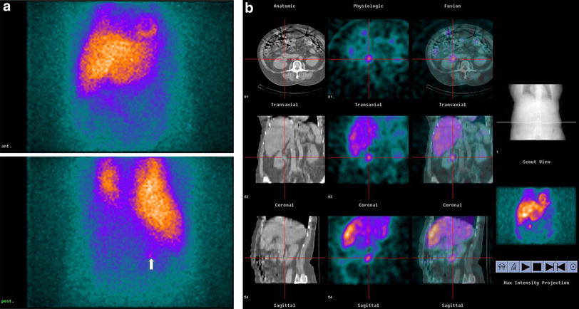 SPECT/CT in neuroendocrine tumours | SpringerLink