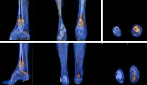 SPECT/CT in infection and inflammation | SpringerLink