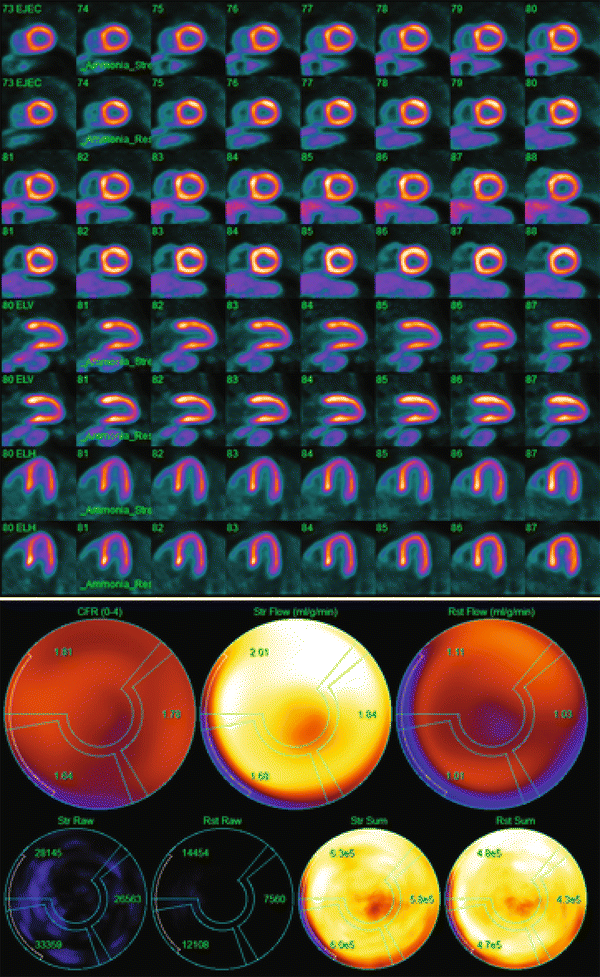 PET myocardial perfusion quantification: anatomy of a spreading