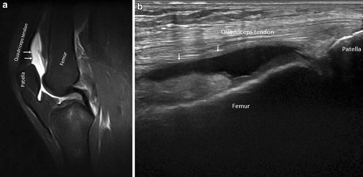 Joint effusion of the knee: potentialities and limitations of