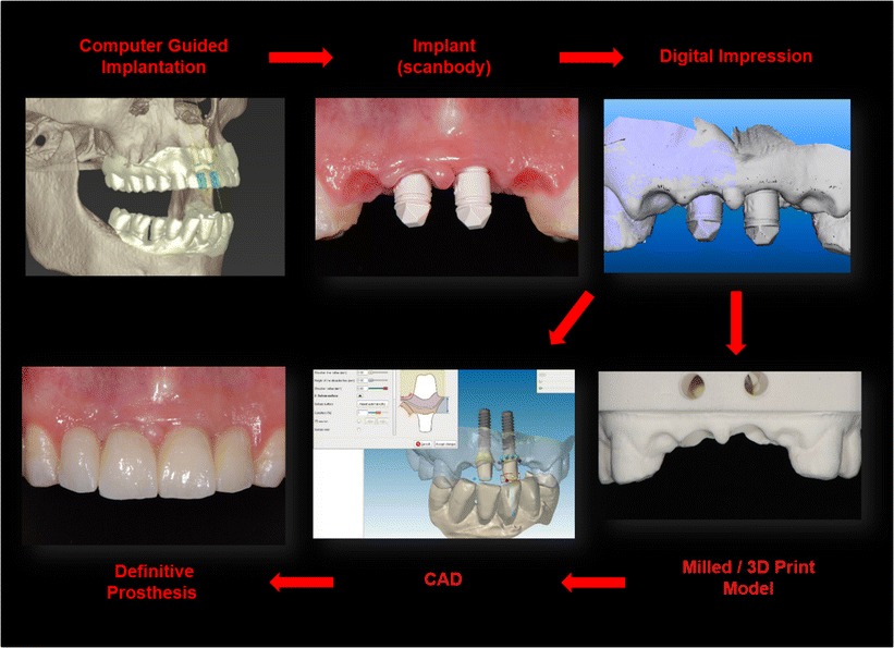 Digital Impressions for ImplantSupported Fixed Dental Prostheses