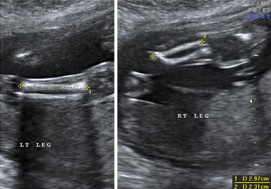 Prenatal Sonographic Features and Postnatal Outcome of Congenital ...