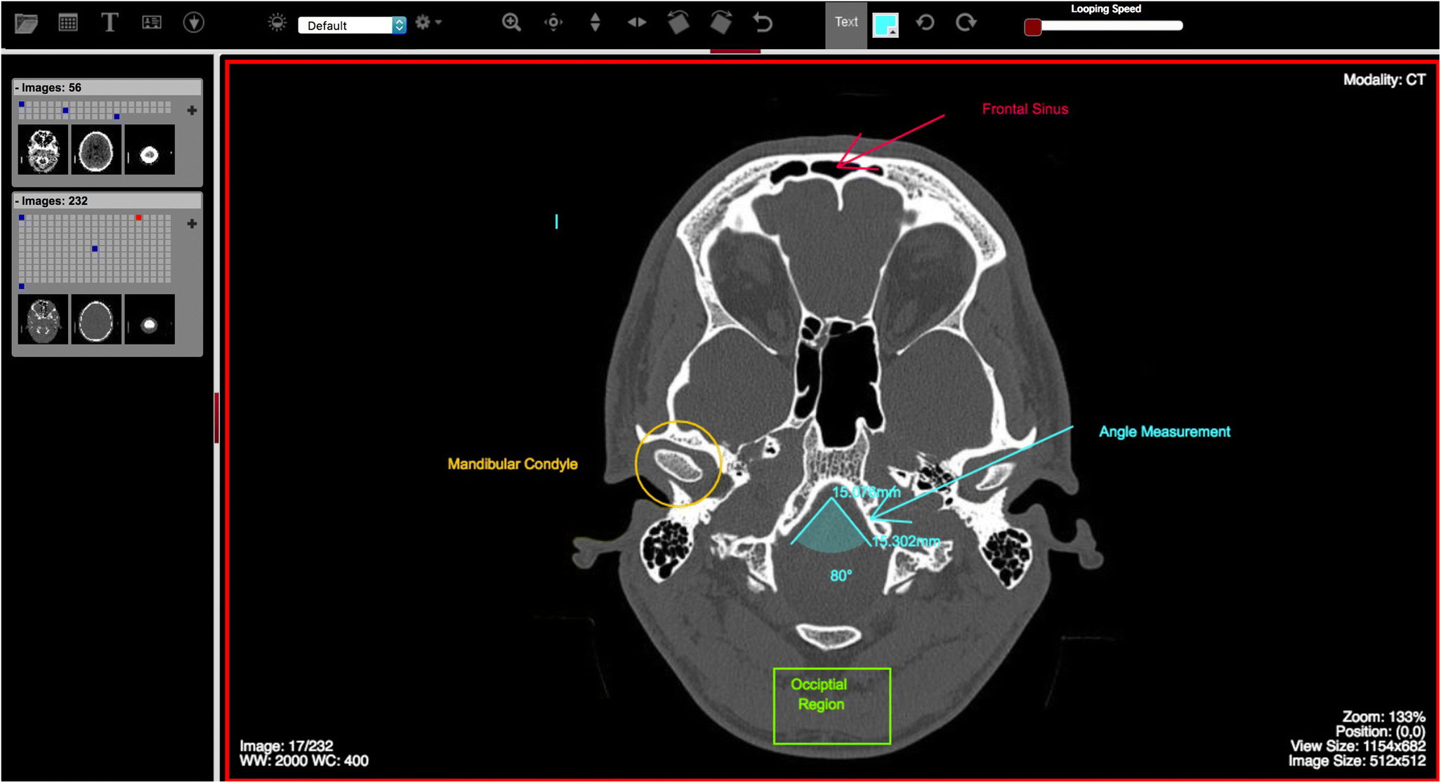 osirix md review