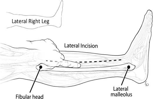 fasciotomy of leg fasciotomy of leg