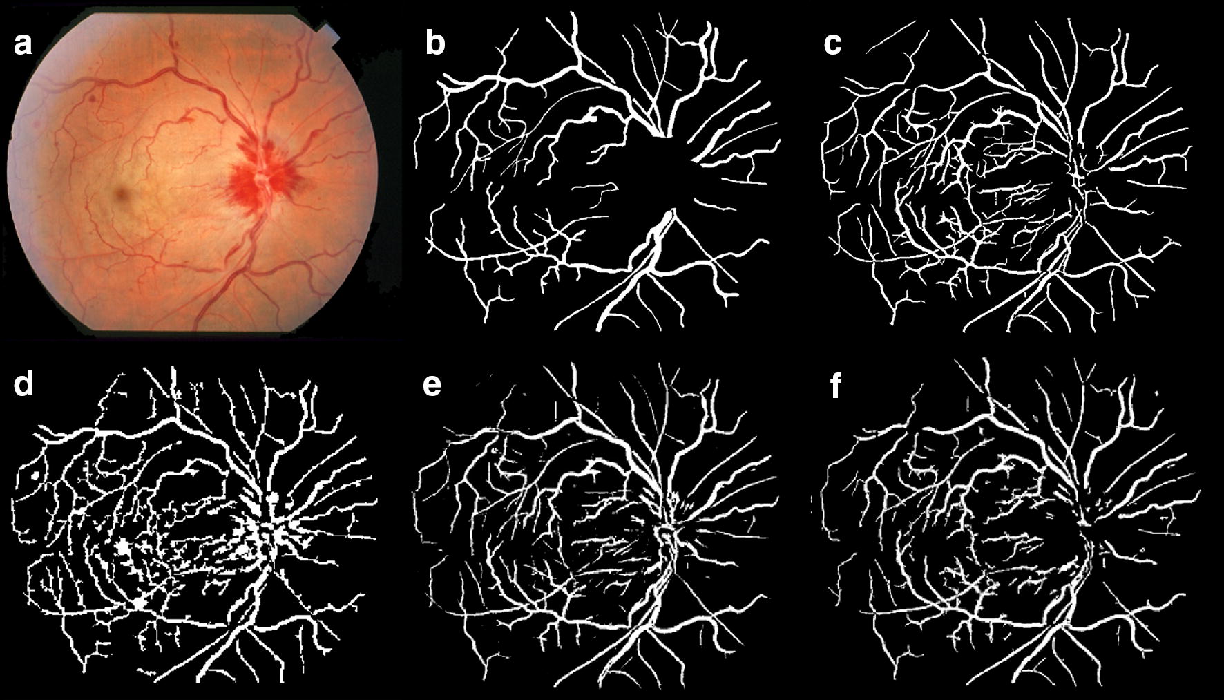 Retinal Blood Vessel Segmentation by Using Matched Filtering and Fuzzy