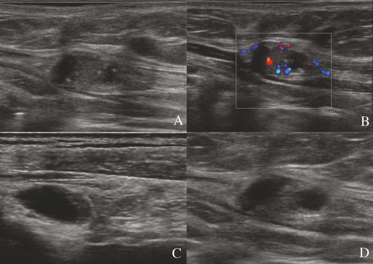 How The Preoperative Ultrasound Examination And Bfi Of The Cervical