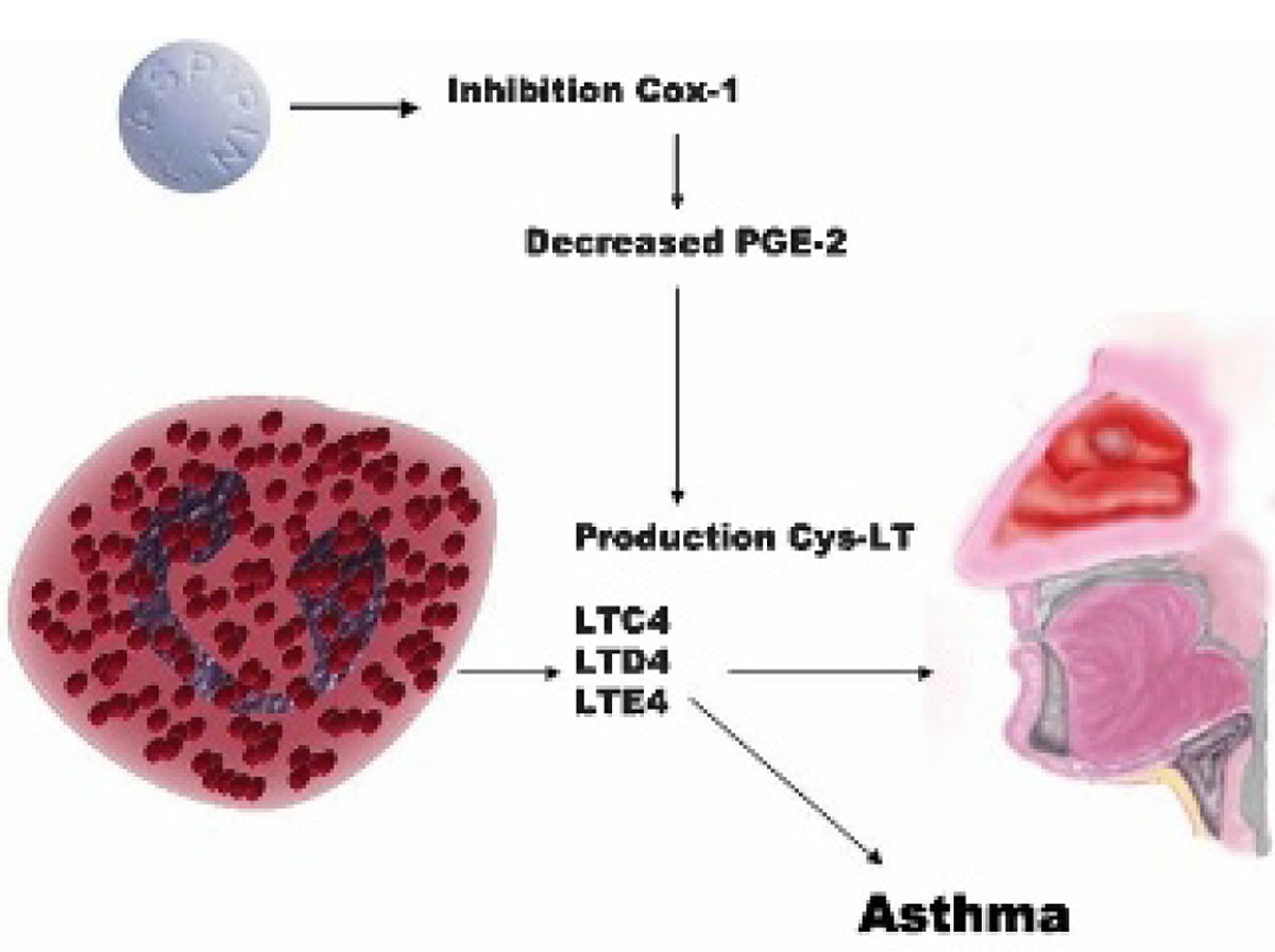 AspirinExacerbated Asthma SpringerLink