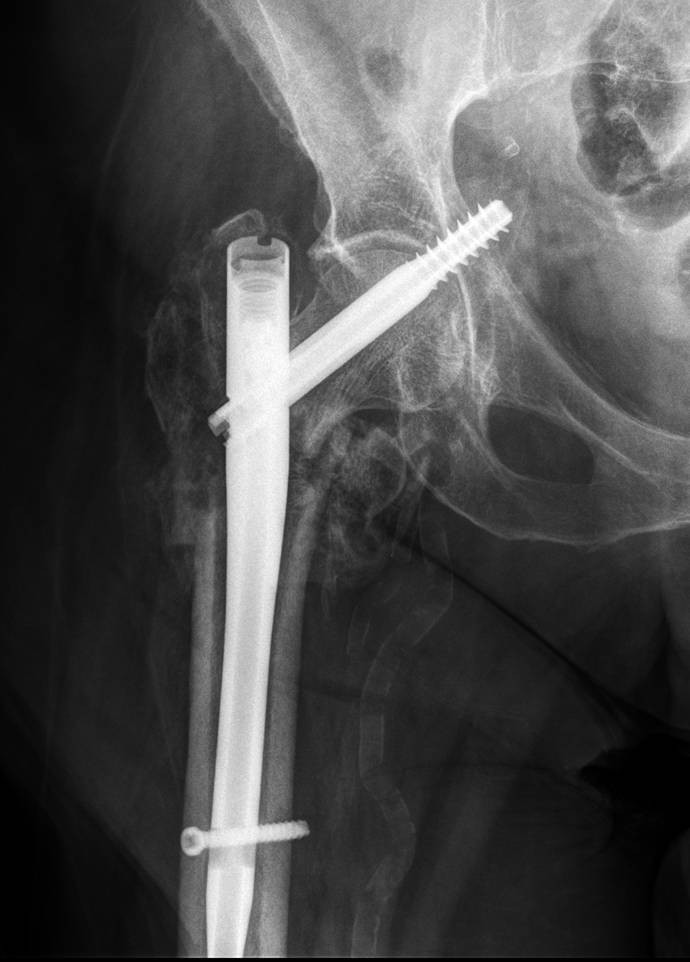 Medial pelvic migration of the lag screw in a short gamma nail after