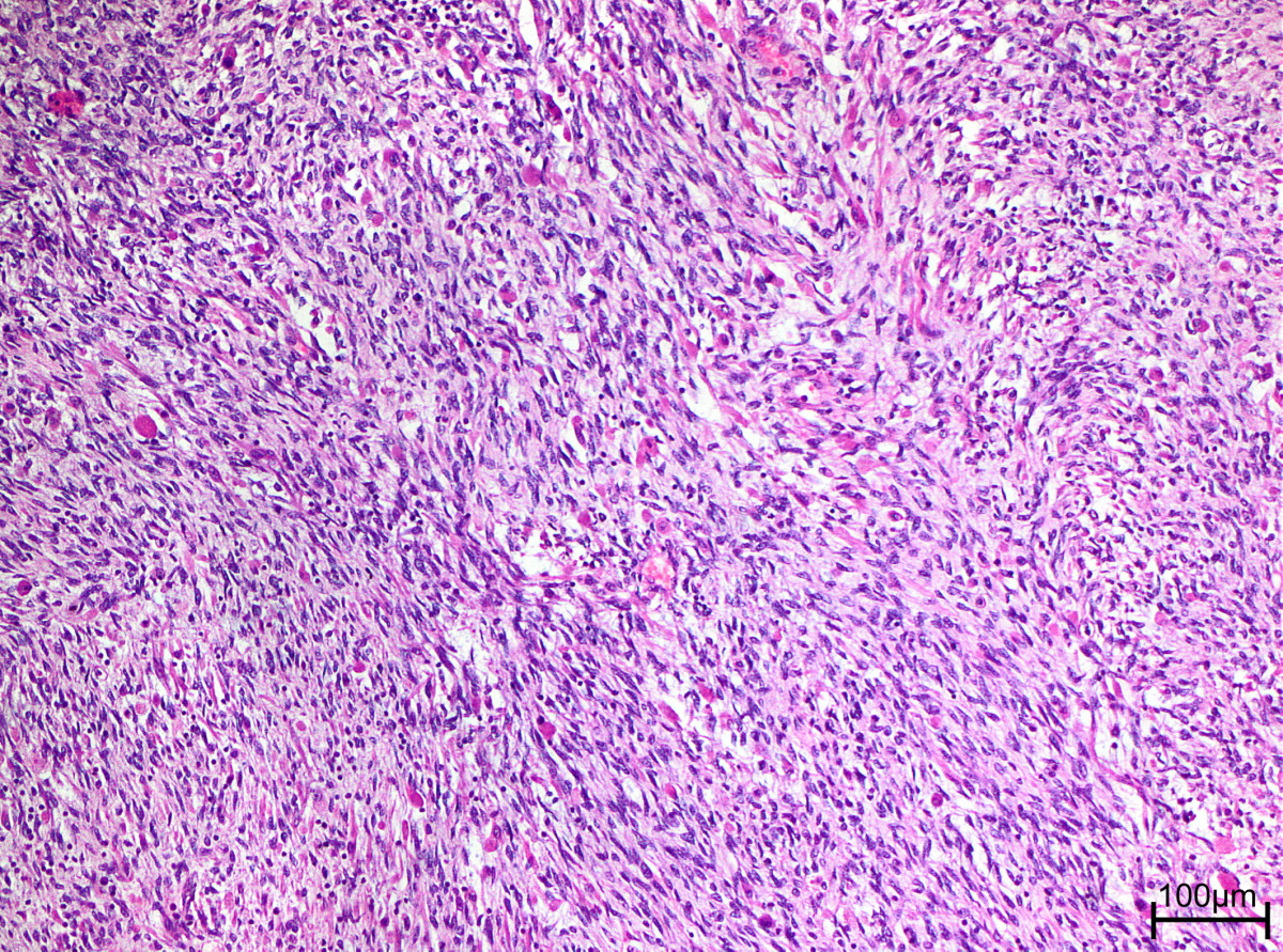 An adult spindle cell in the head and neck region with