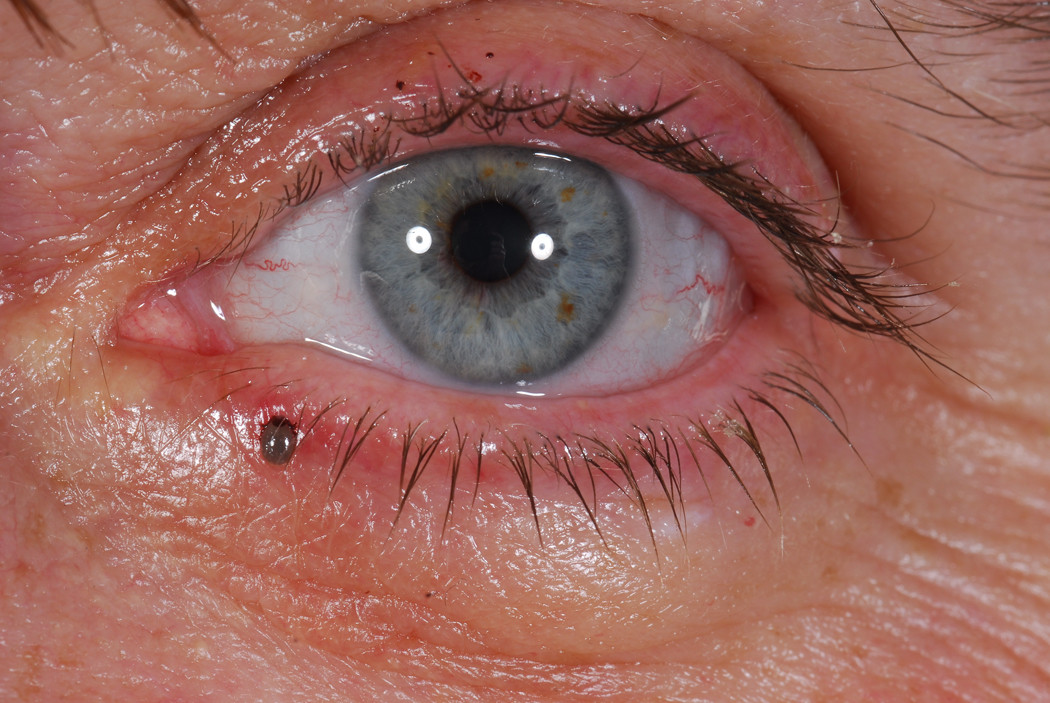Tiki Eye Rash Tick infestation on the lower eyelid: a case report | SpringerLink