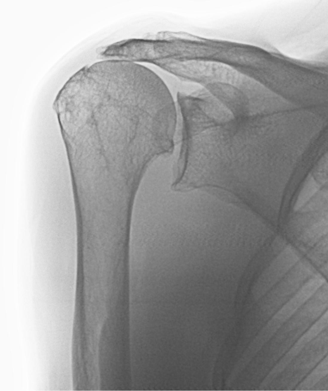 Management of degenerative rotator cuff tears a review and treatment