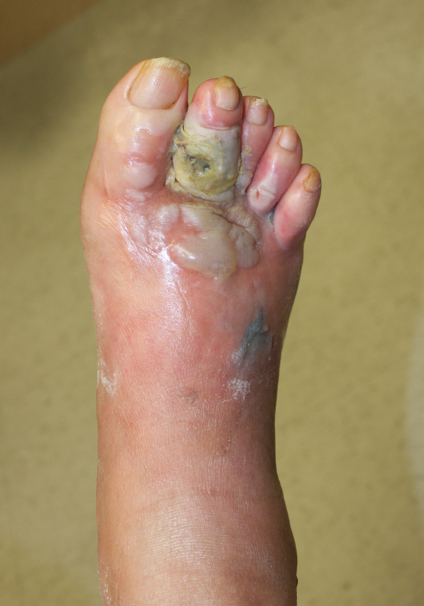 Gas gangrene and osteomyelitis of the foot in a diabetic patient