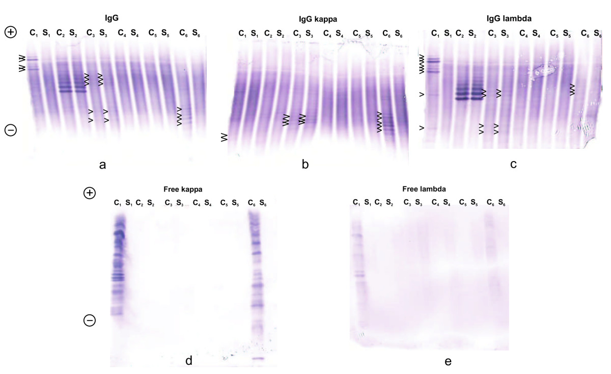 Detection of oligoclonal IgG kappa and IgG lambda bands in