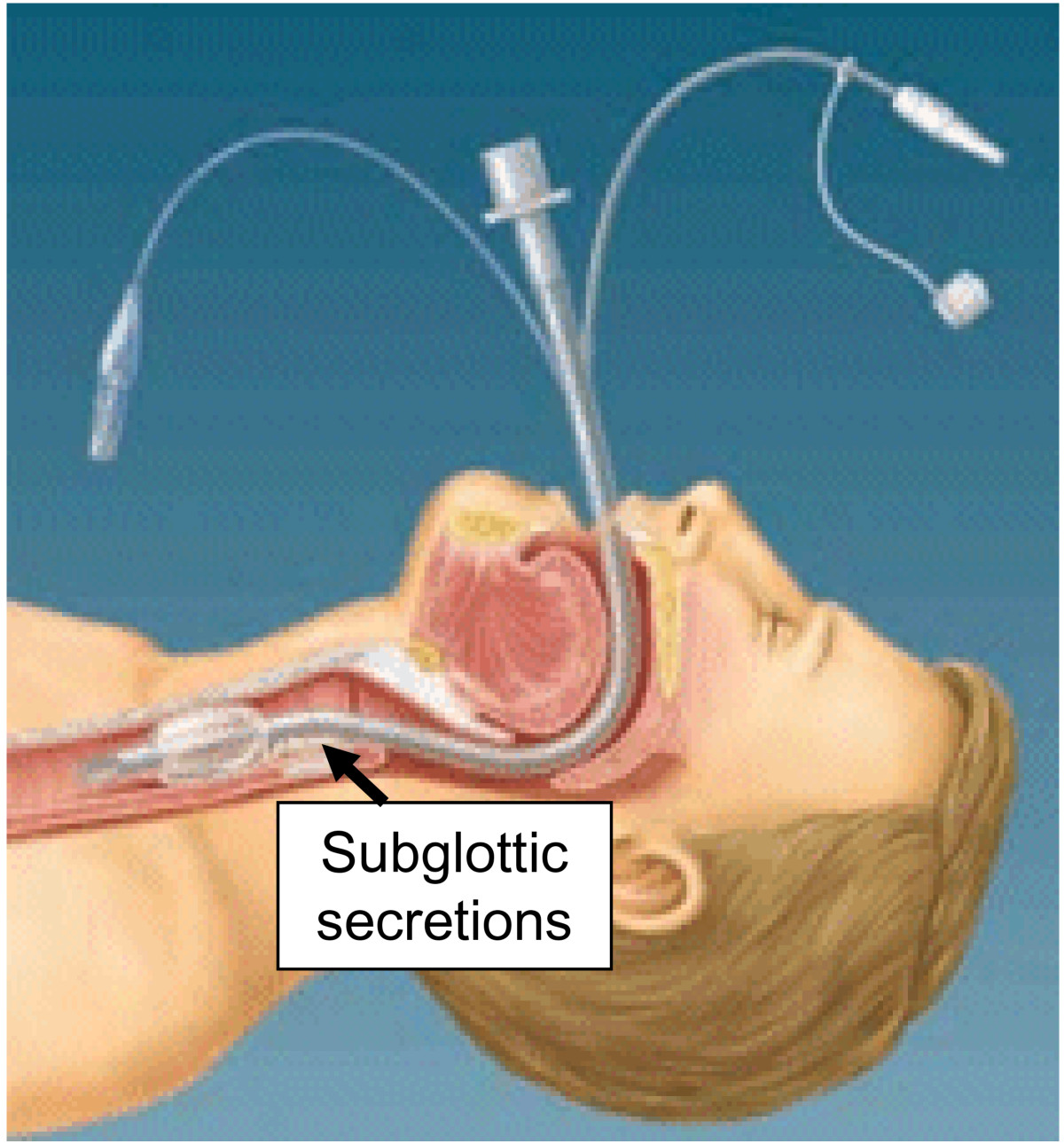 The tracheal tube gateway to ventilatorassociated pneumonia