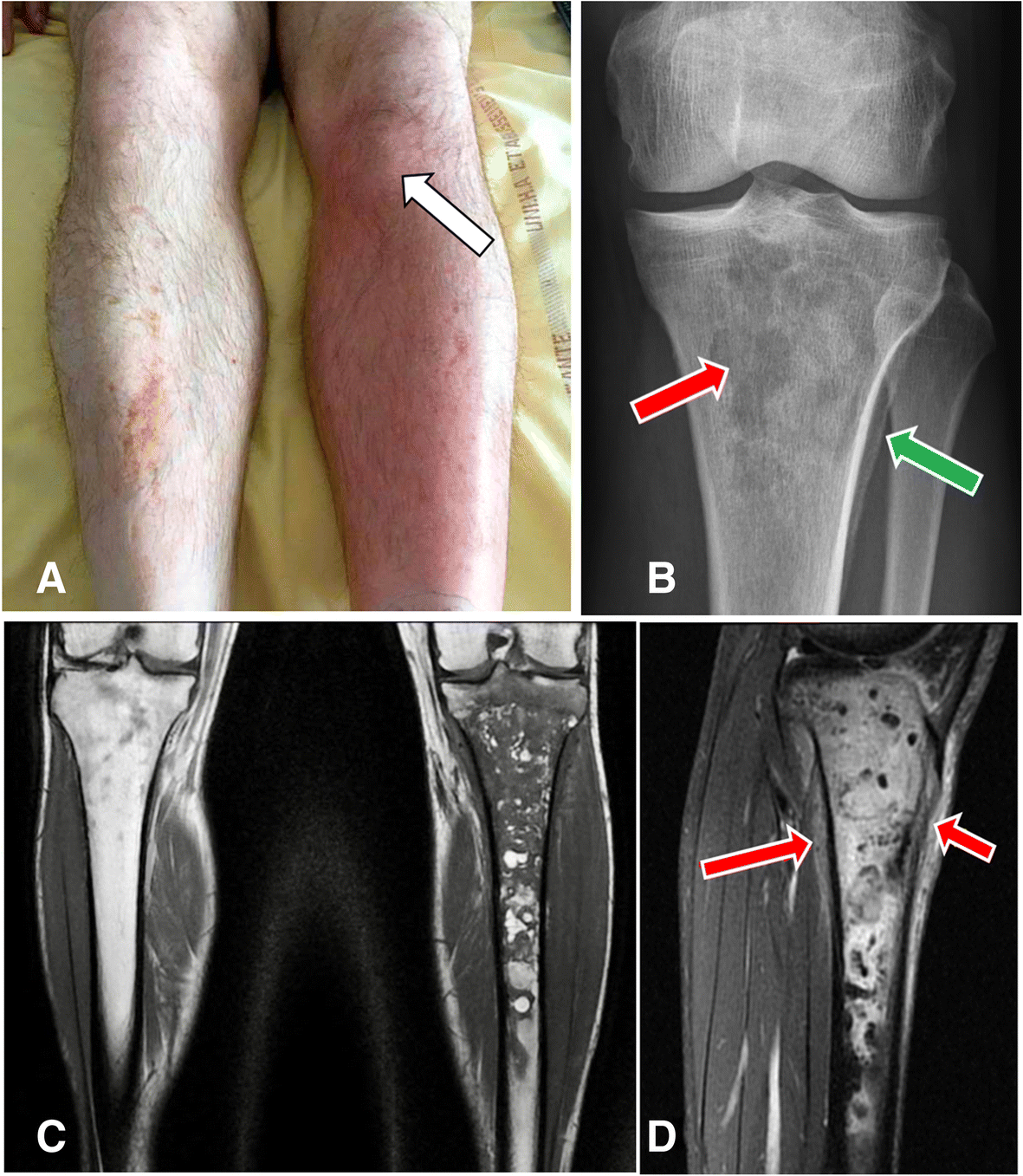 Acute Tibial osteomyelitis caused by intraosseous access during initial