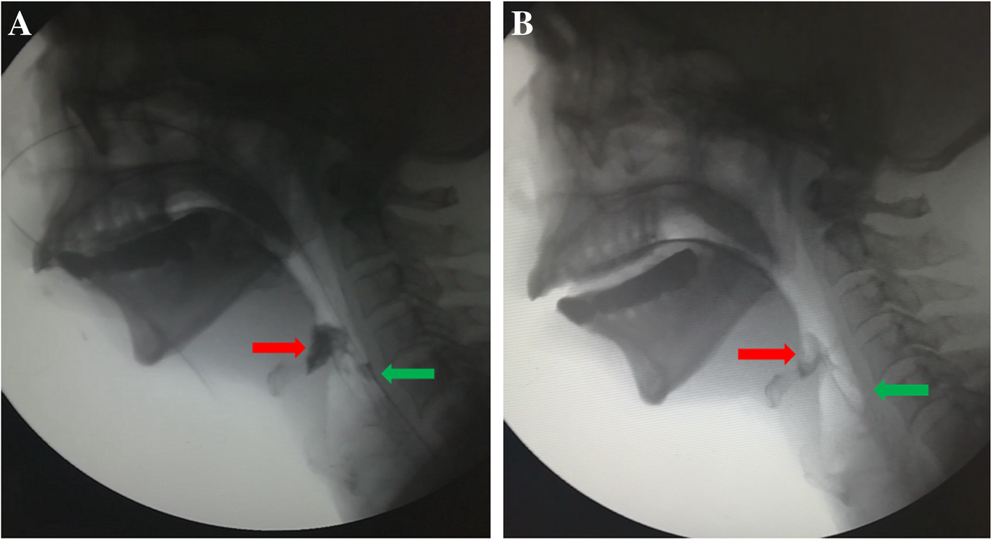 Effect of an indwelling nasogastric tube on swallowing function in elderly poststroke dysphagia