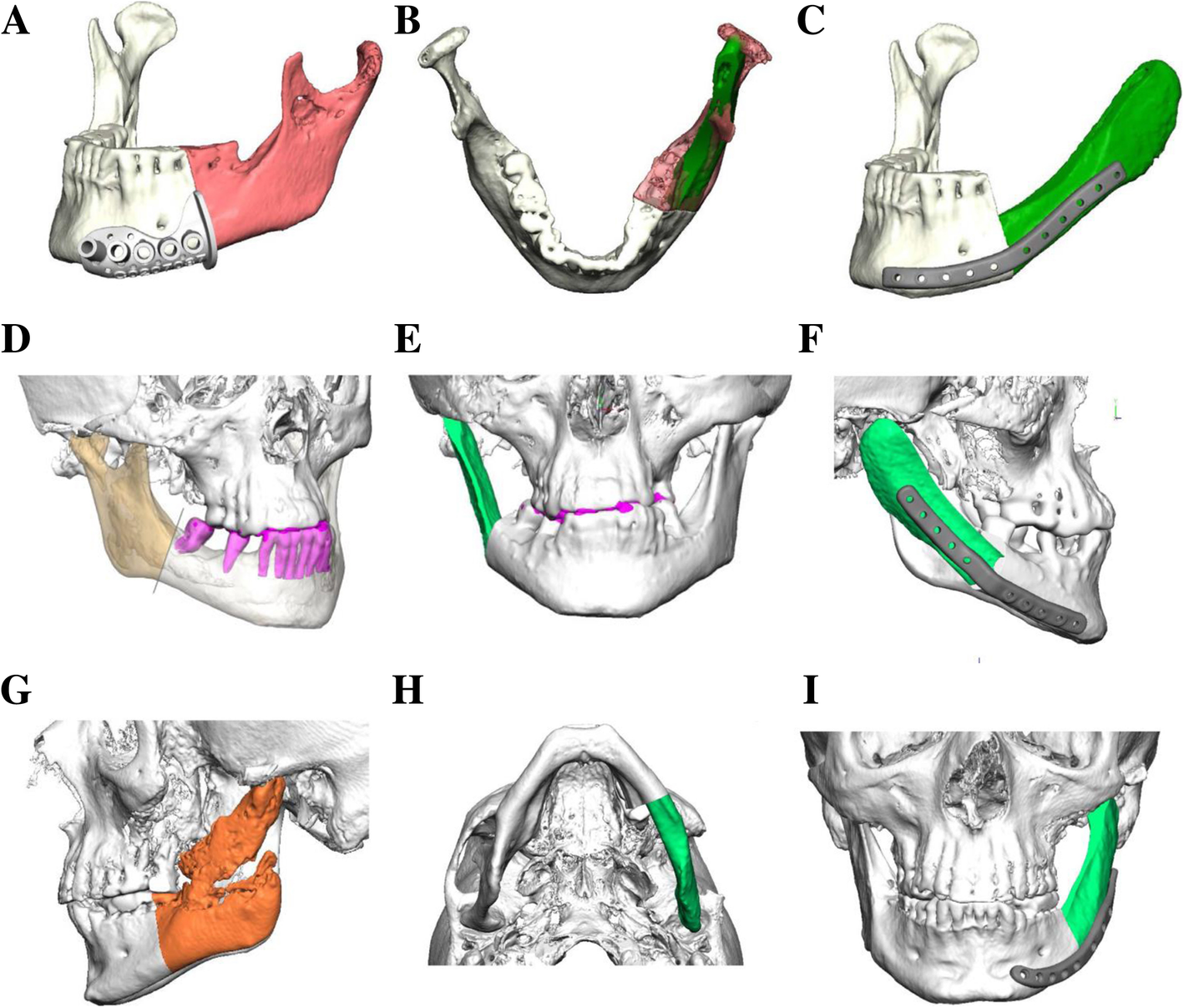 Vascularized scapula and latissimus dorsi flap for CAD/CAM assisted