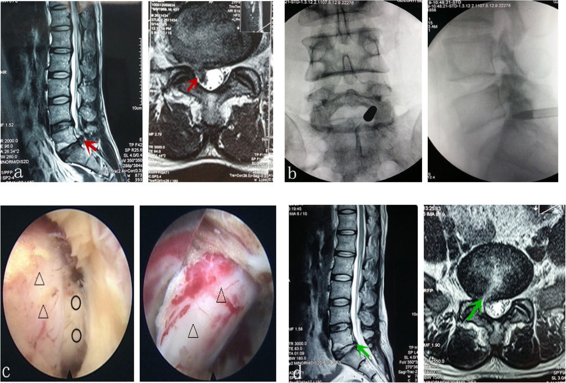 Treatment of L5 S1 intervertebral disc herniation with