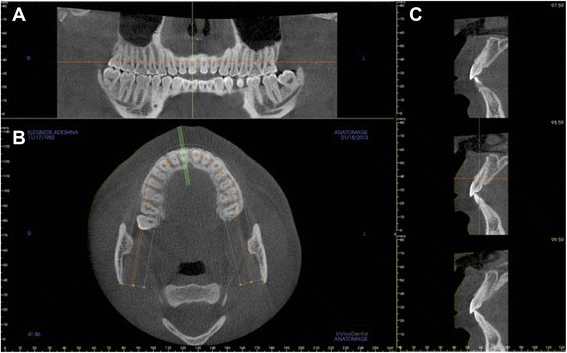 Anterior maxilla alveolar ridge dimension and morphology measurement by ...